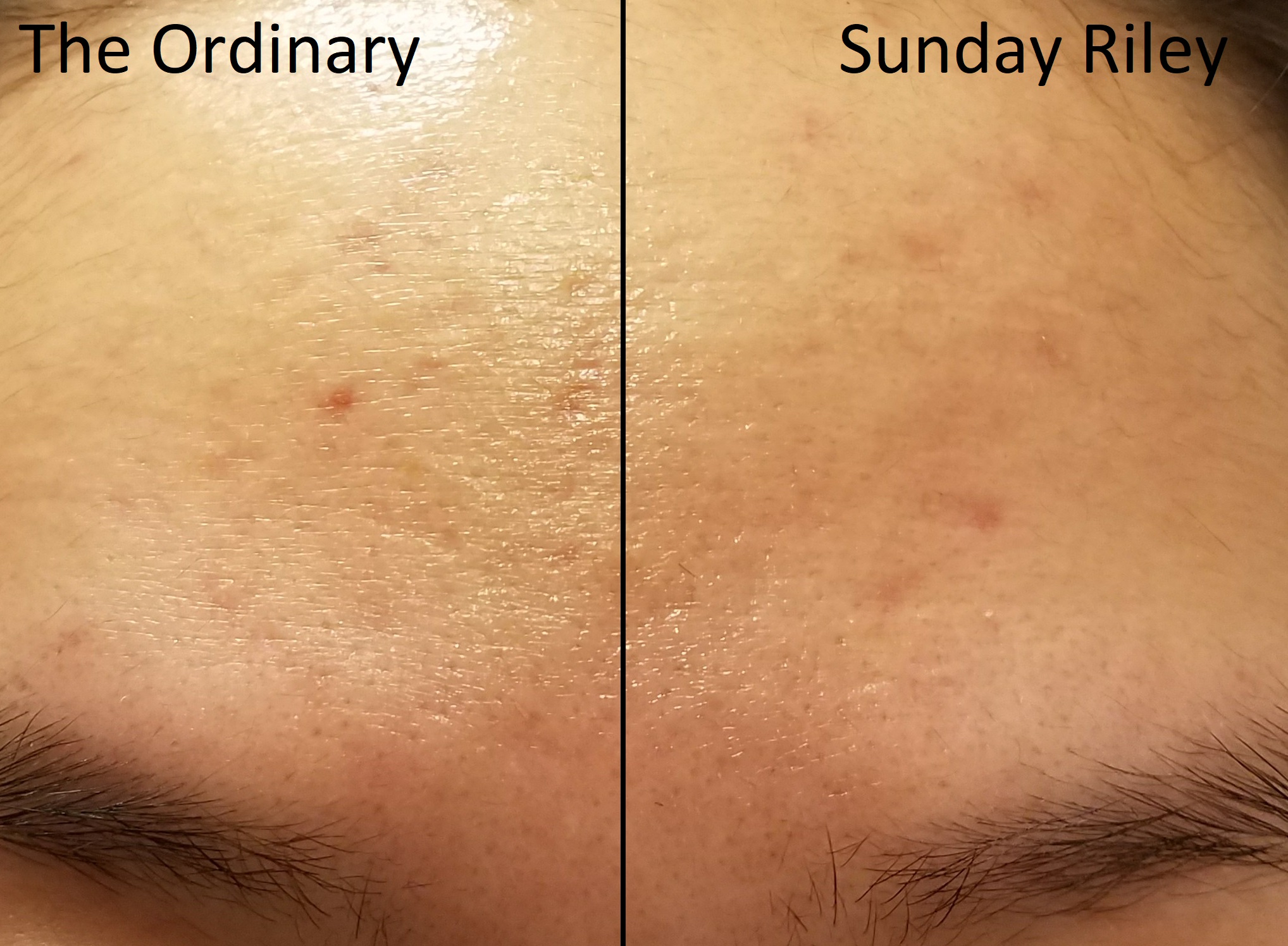 Sunday Riley “Good Genes” on Acne Scars & Fine Lines. Before AND Afters ...2036 x 1496